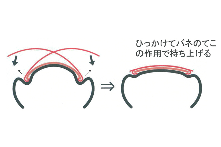 そがわ式巻き爪矯正法画像